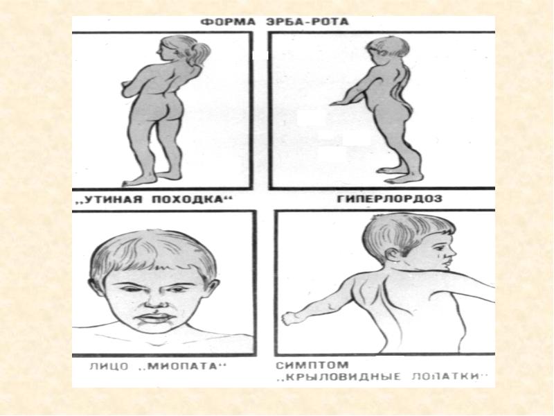 Моногенные заболевания картинки