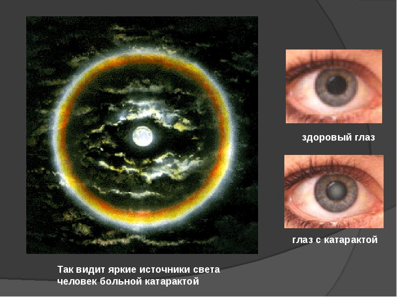 Как видит человек с глаукомой картинки