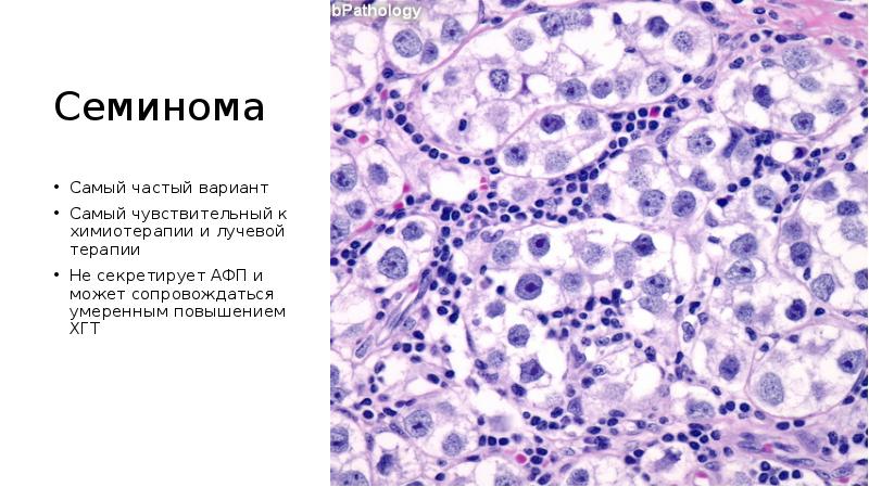 Семинома. Сперматоцитарная семинома с саркомой. Гистологические варианты семиномы.