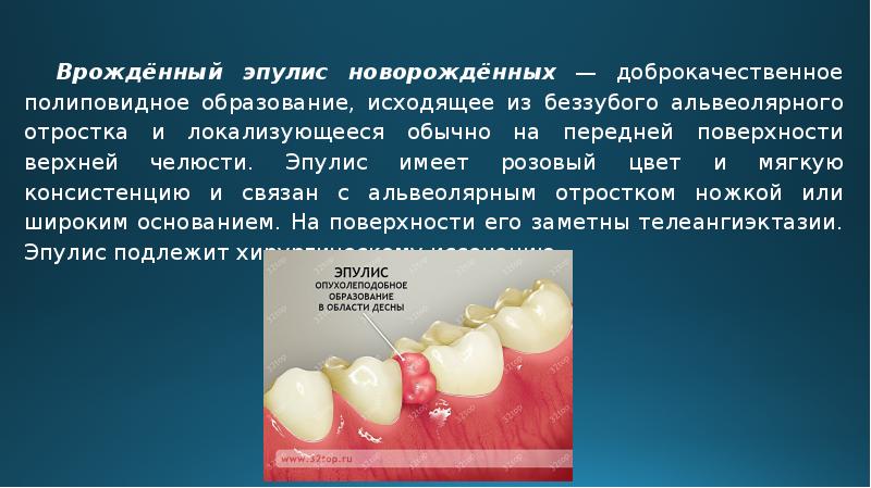 Декубитальная язва мкб. Заболевания полости рта. Болезни полости рта и десен. Понятие заболеваний полости рта.