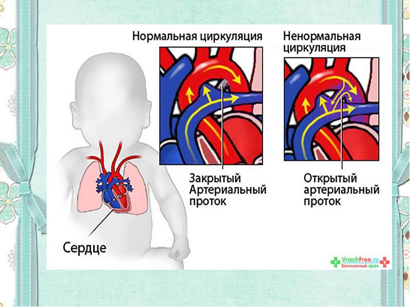 Жүрек ақаулары презентация