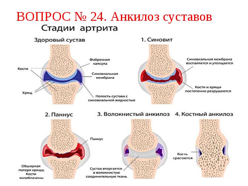 Болезни суставов презентация