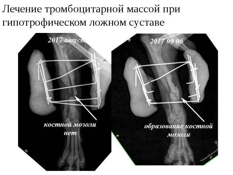 Ложные суставы презентация