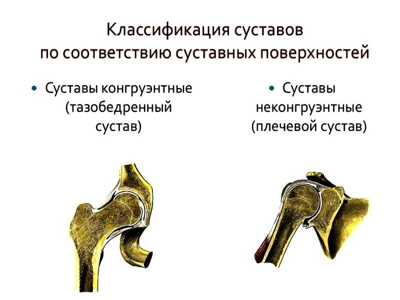 Болезни суставов презентация