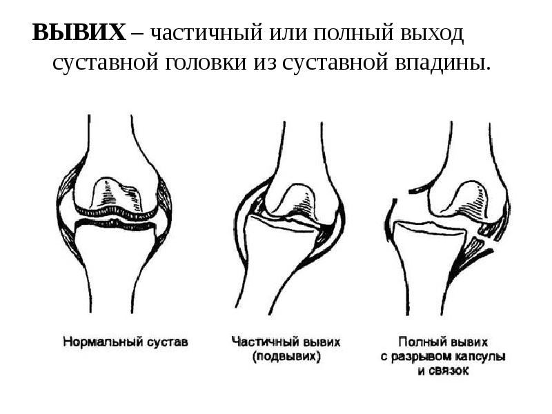 Картинка вывиха сустава