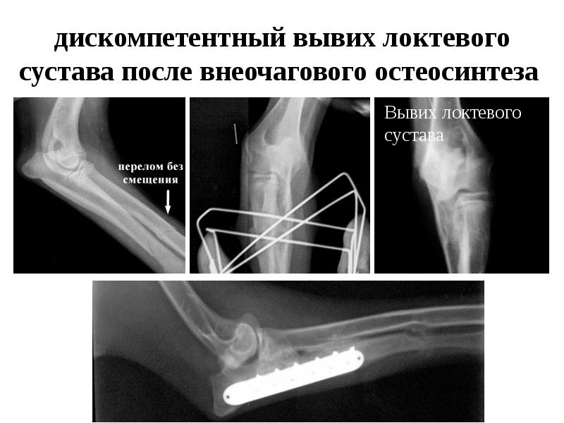 Вывихи предплечья презентация