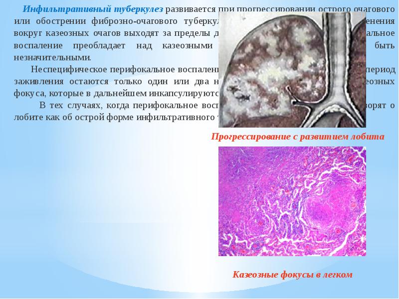 Фиброзно очаговый туберкулез легких. Фиброзно очаговый туберкулез легких