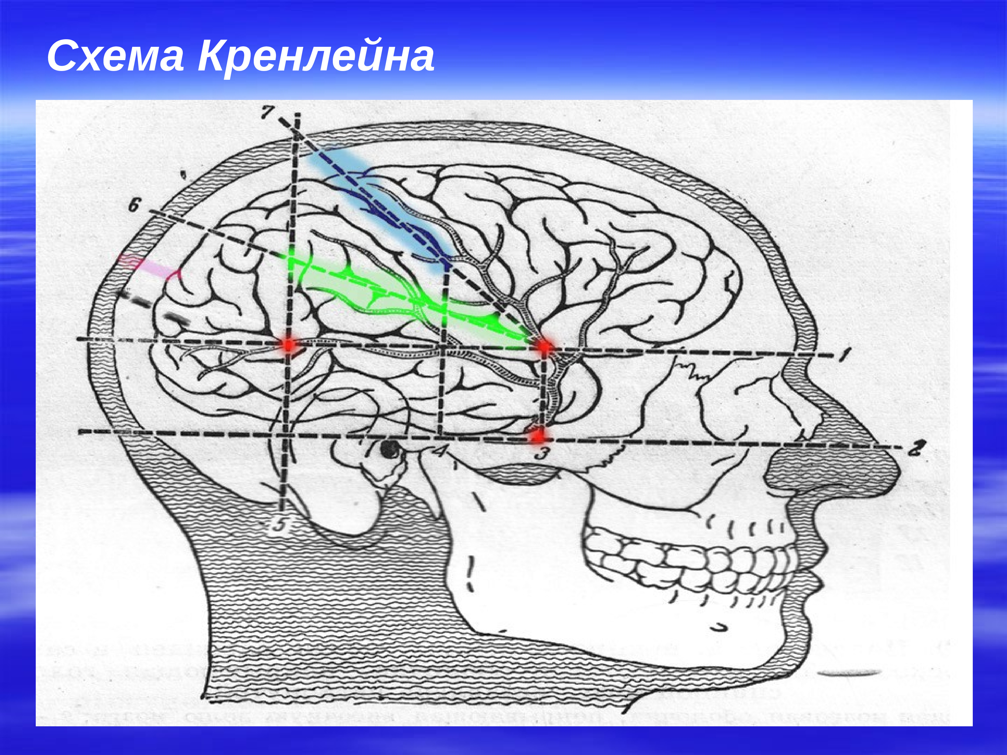 Схема кренлейна брюсовой для чего