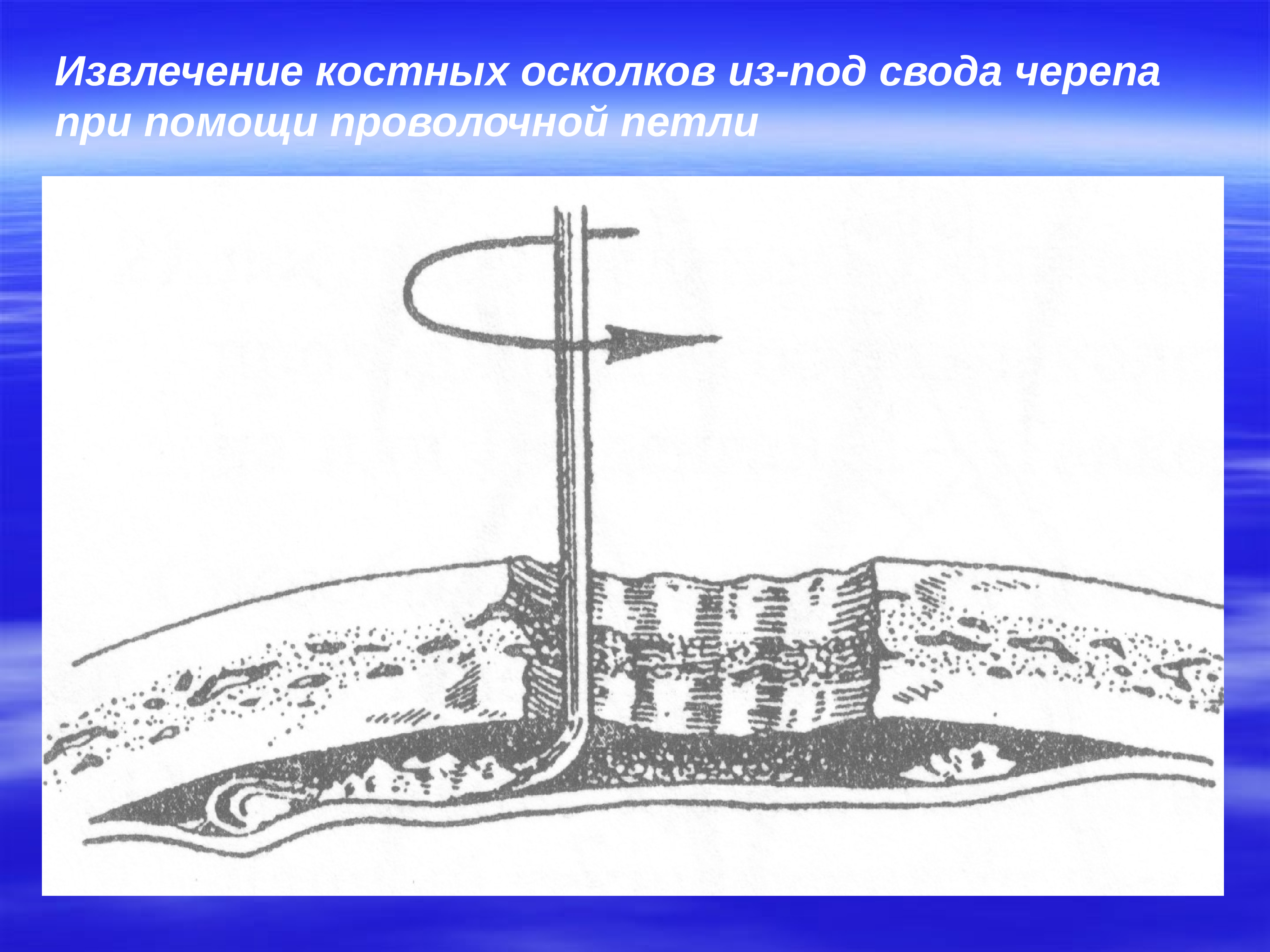 Извлечение атрибутов. Феномен проволочных петель. Симптом проволочной петли. Извлечение осколка прокол.