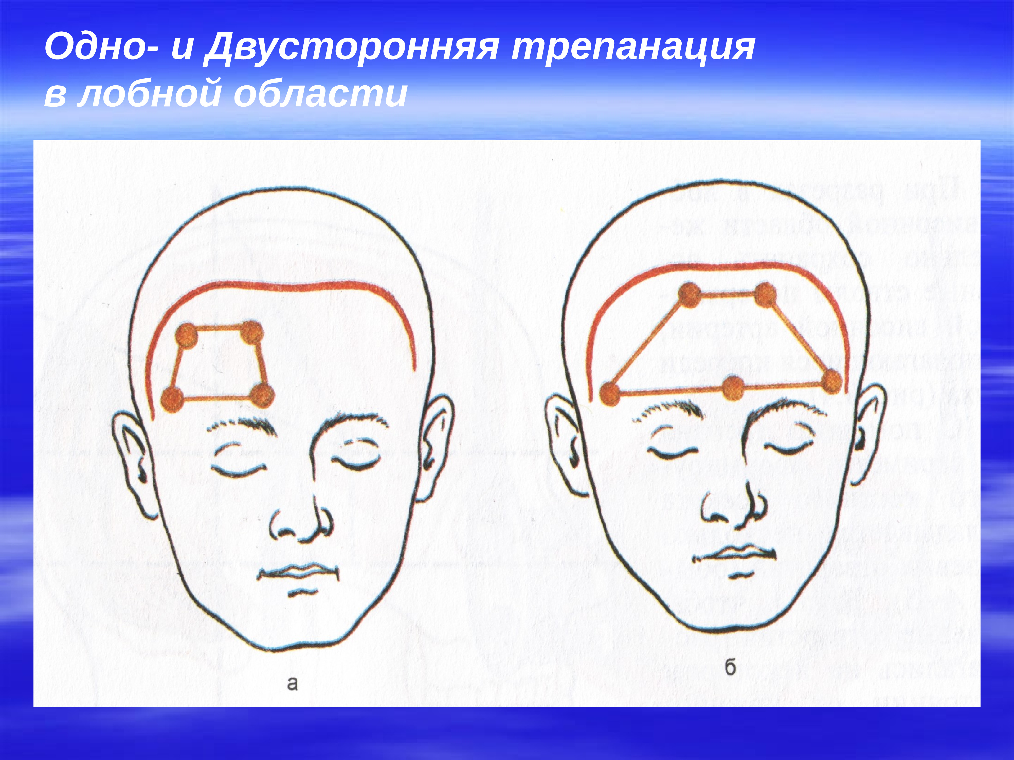 Следующая голова. Лобная область. Операция в области головы. Операция в лобной части головы.