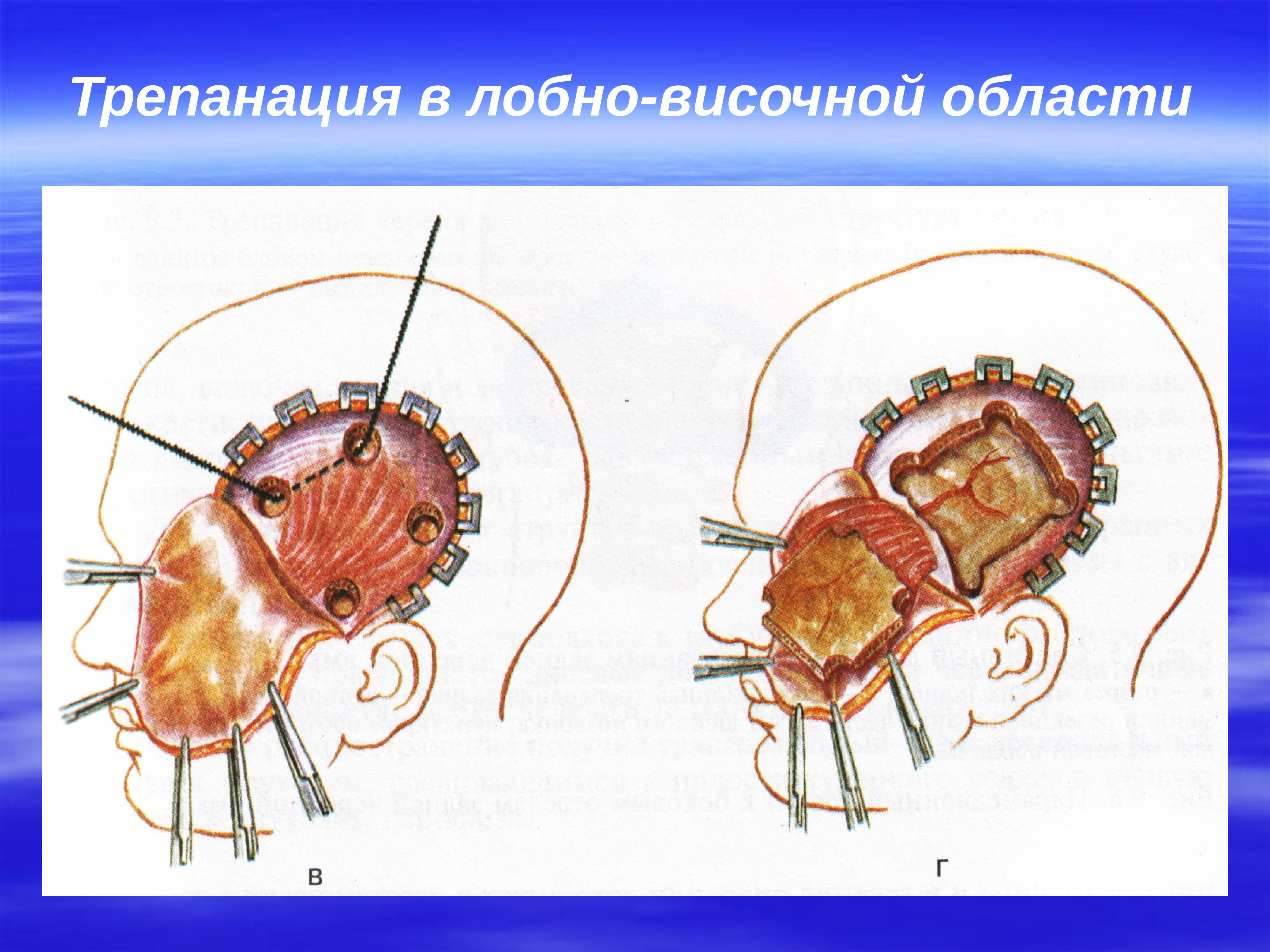 Трепанация это. Трепанация черепа височная область. Трепанация лобной области. Бифронтальная Трепанация.