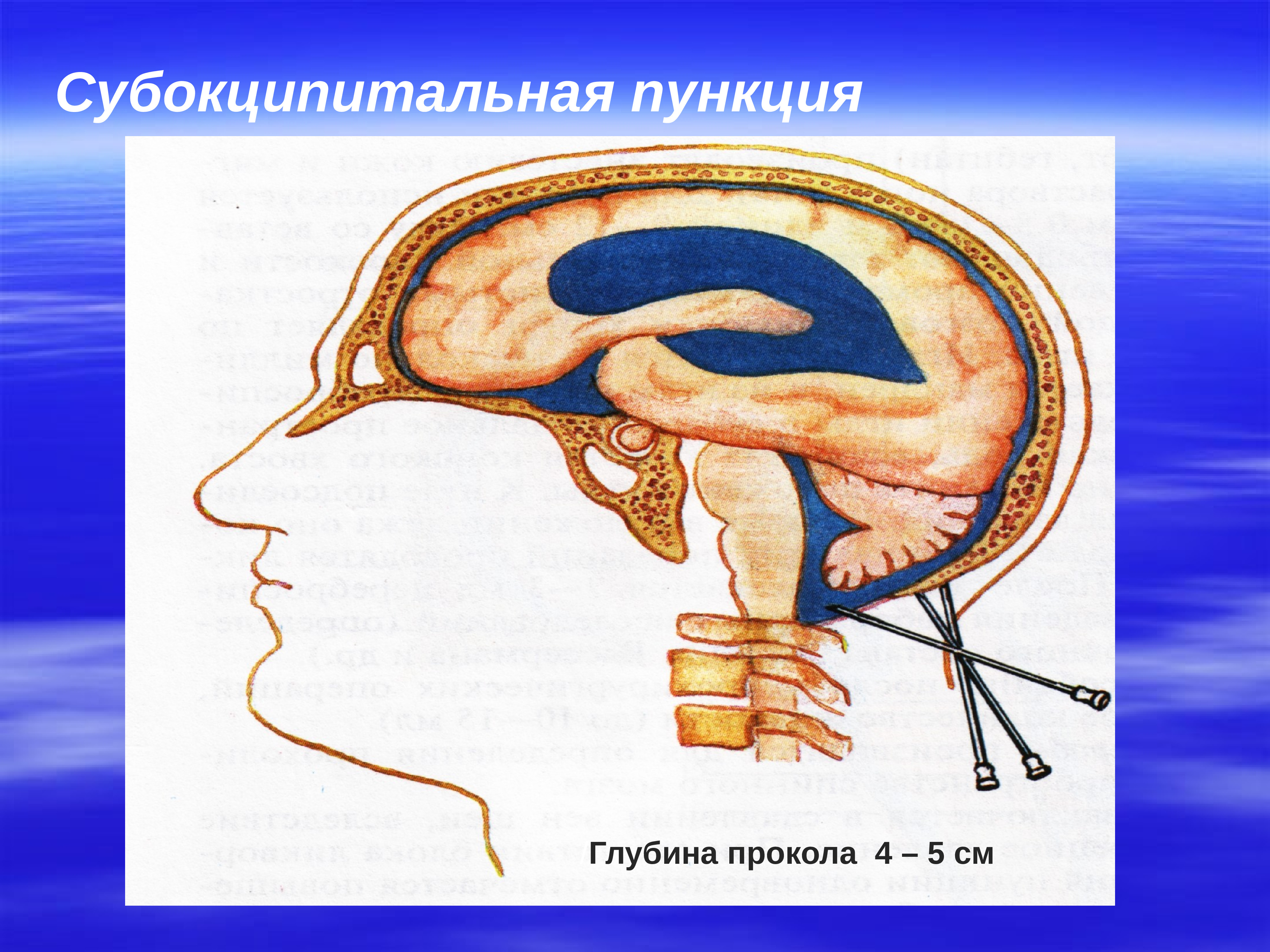 Пункция мозга. Цистернальная пункция это. Субокципитальный ликвор. Пункция цистерны мозга. Субокципитальное Введение.