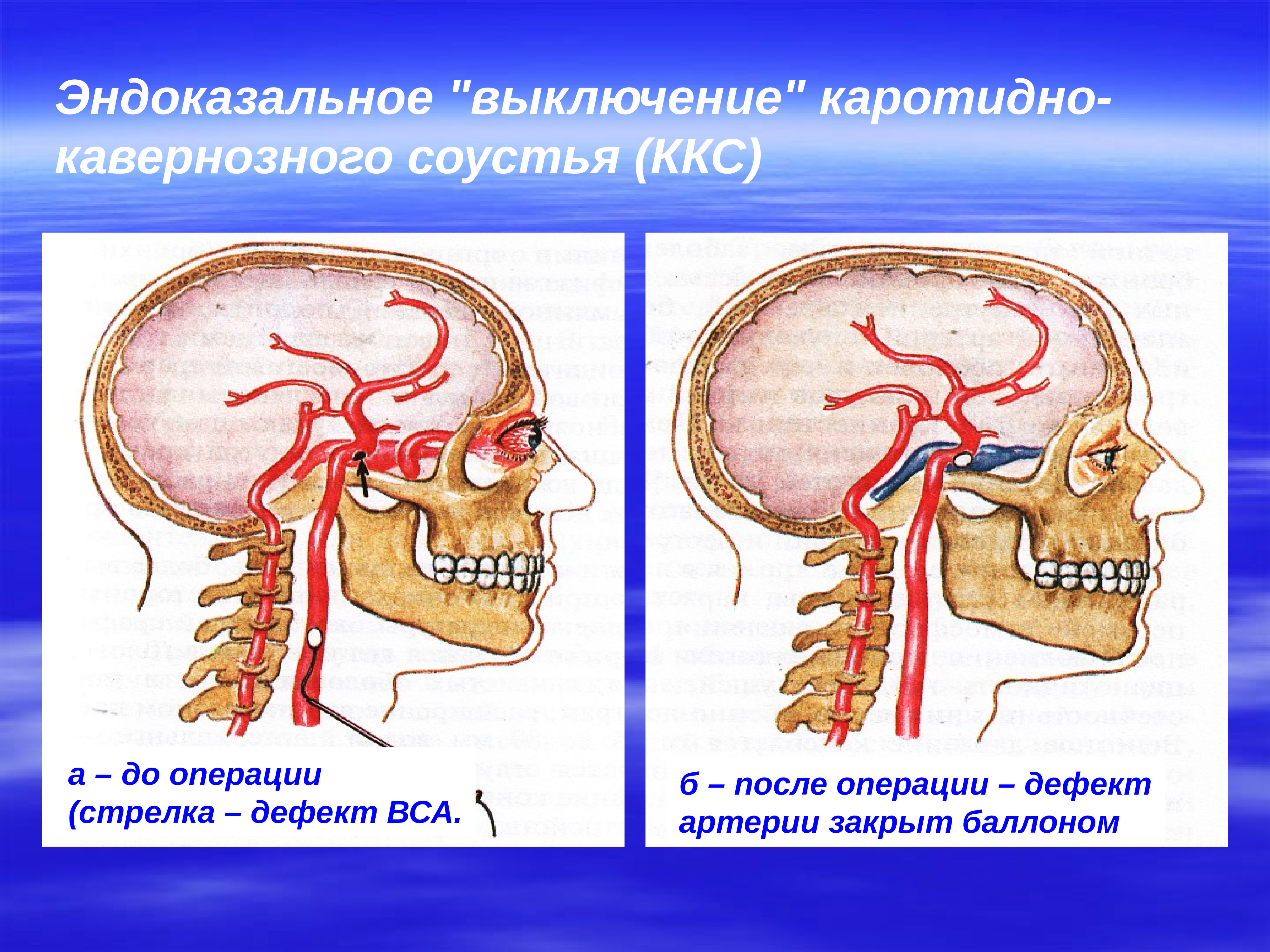 Соустье. Кавернозно каротидное соустье. Тромбоз каротидно-кавернозного соустья. Операция каротидно-кавернозное соустье. Каротидно-кавернозное соустье кт.