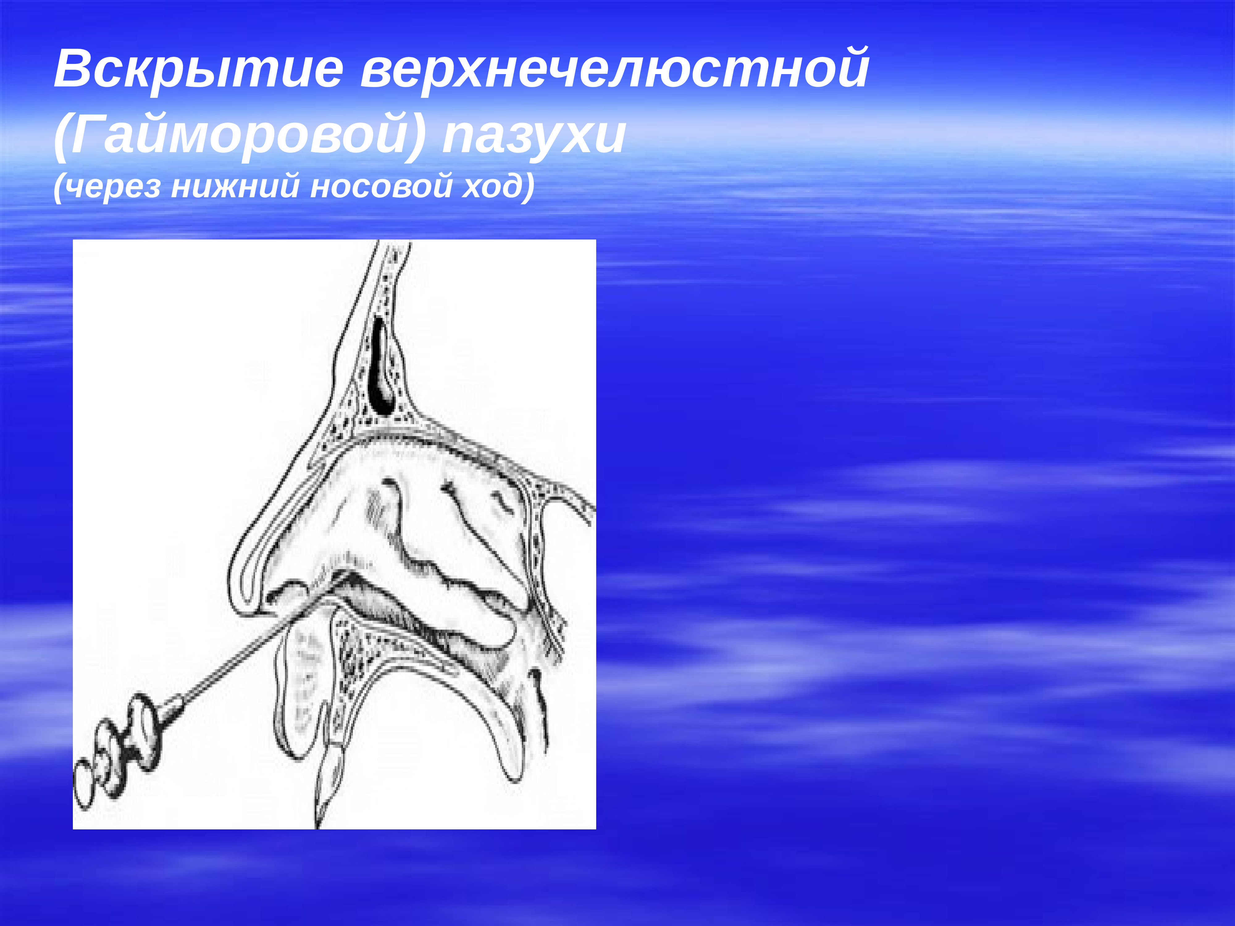 Соустье гайморовой пазухи. Пункция гайморовой пазухи ход операции. Трепанация гайморовой полости. Операция на верхнечелюстной пазухе. Пункция верхнечелюстной пазухи через Нижний носовой ход.