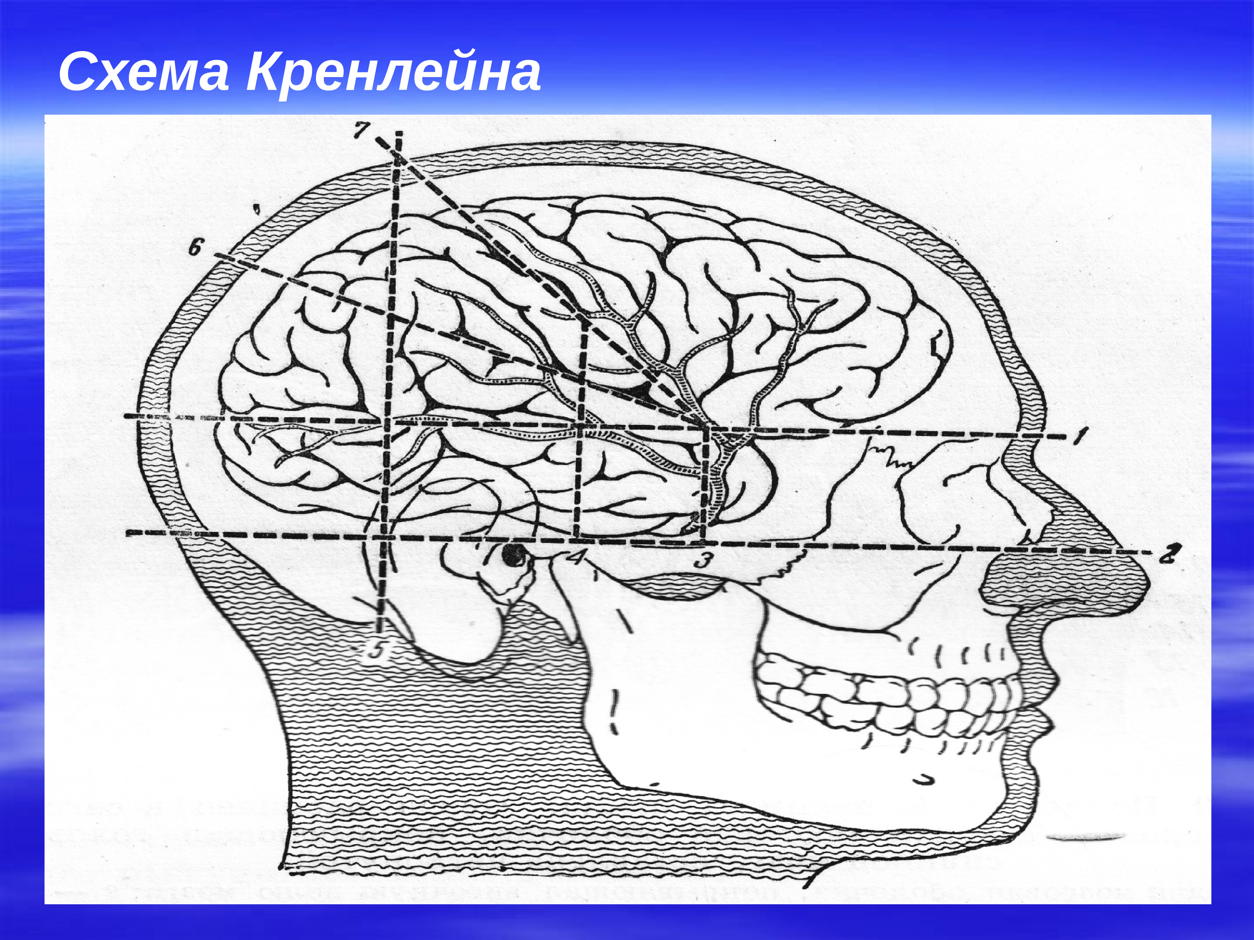 Схема служащая для ориентировки в черепно мозговой топографии