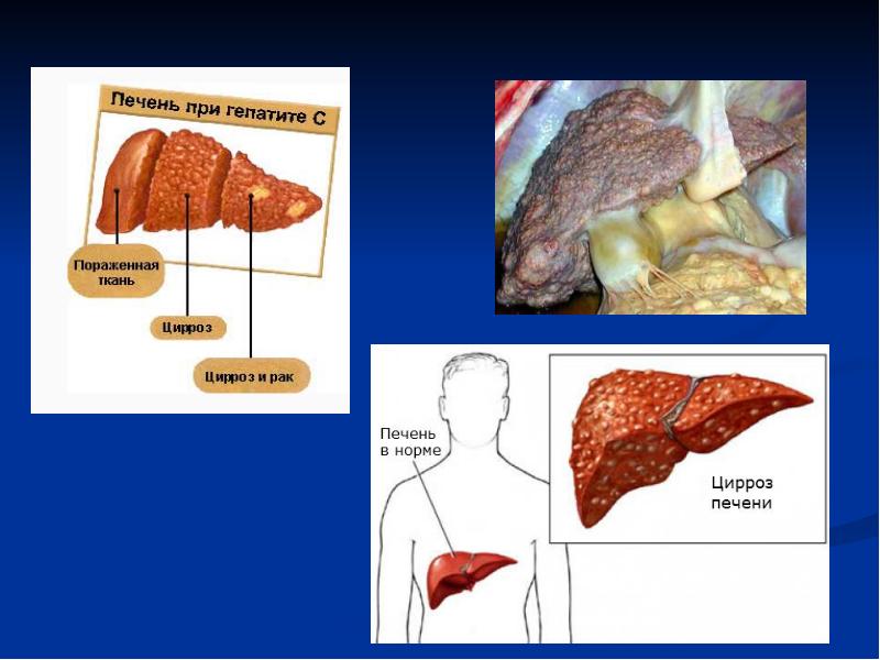 Презентация про гепатит с
