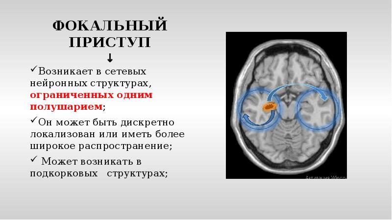 Невролог эпилепсия