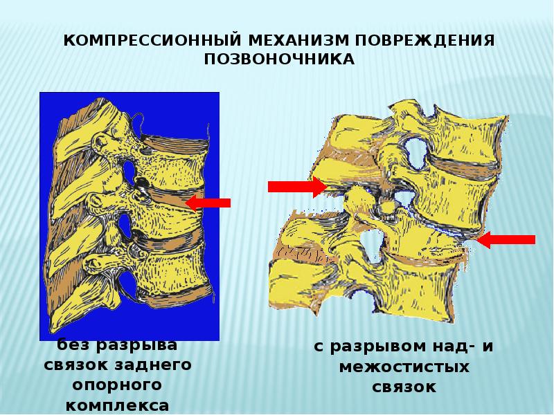 Клиническая картина травм позвоночника