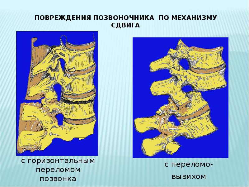 Перелом позвоночника презентация