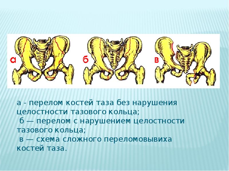 Переломы таза травматология презентация