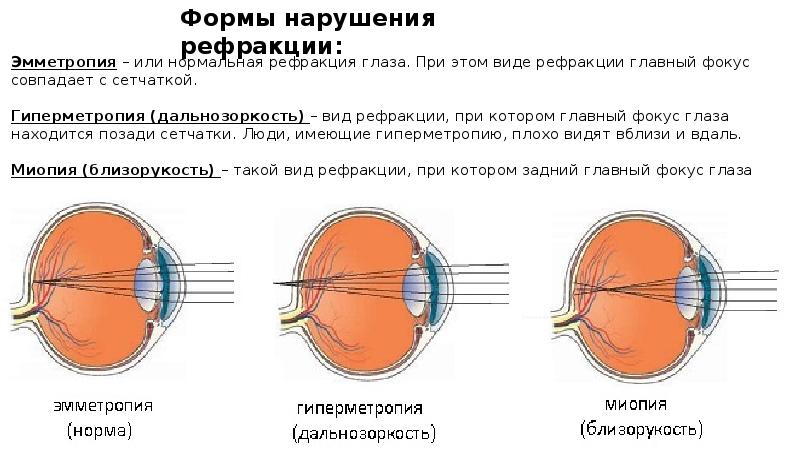 Миша страдает близорукостью а его брат дальнозоркостью. Аномалии рефракции глаза астигматизм. Эмметропия миопия гиперметропия. Аномалии рефракции: дальнозоркость, близорукость, астигматизм.. Схема глаза эмметропии.