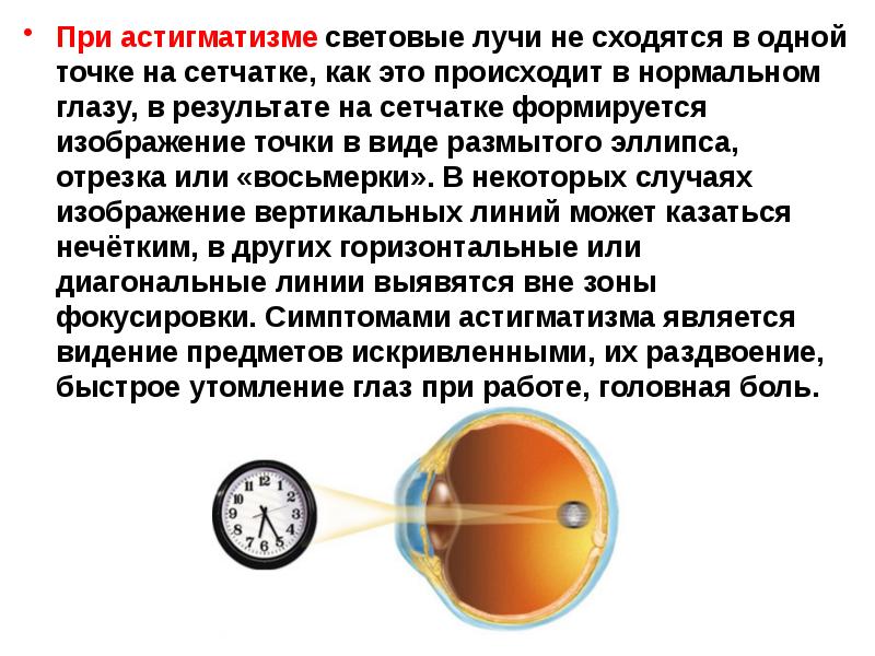 Астигматизм можно ли. Астигматизм сетчатки. Вертикальный астигматизм. Астигматизм причины возникновения. На сетчатке формируется.