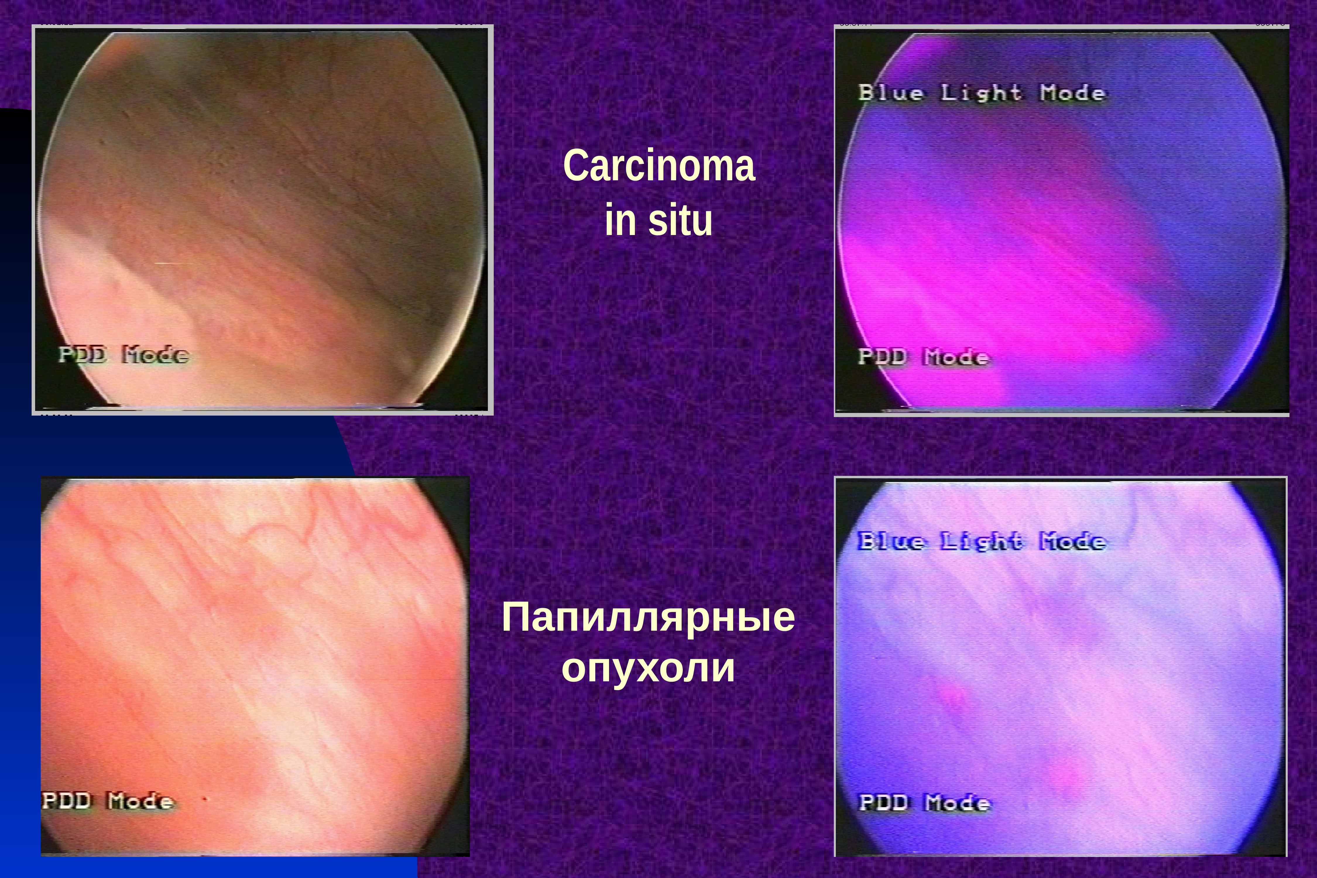 Канцер ин ситу микропрепарат. Стадии опухоли толстой кишки. Новообразования in situ. Новообразования in situ. Слизистая оболочка толстой кишки.