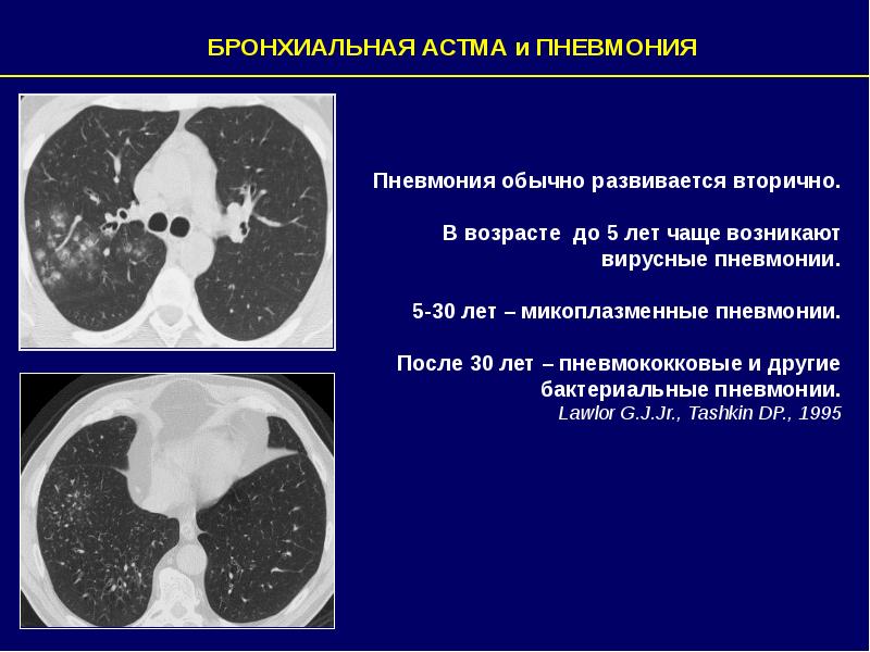 Лучевая диагностика пневмоний презентация