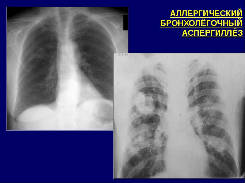 Аллергический бронхолегочный аспергиллез презентация