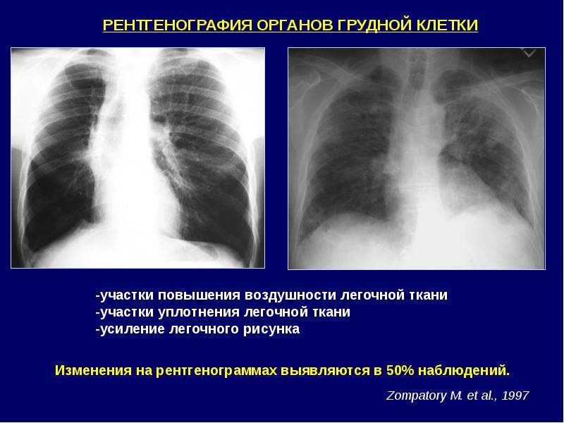 Легочный рисунок обогащен деформирован