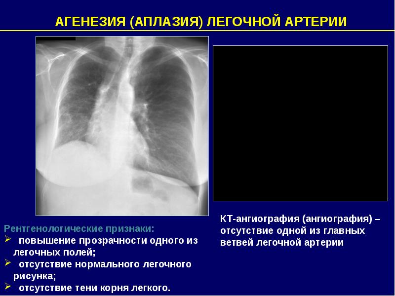 Отсутствие легочного рисунка