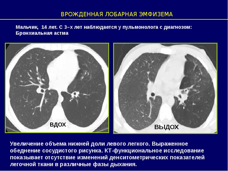 Врожденная лобарная эмфизема клиника рентгенологическая картина принципы лечения