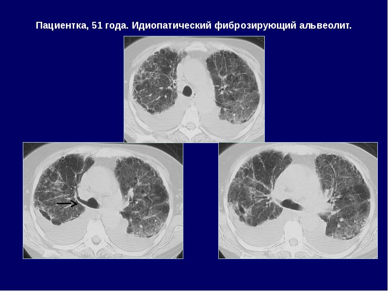 Презентация идиопатический фиброзирующий альвеолит