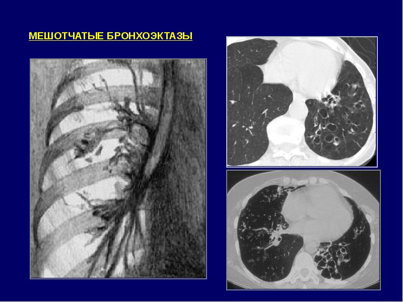 Кт картина бронхоэктазов