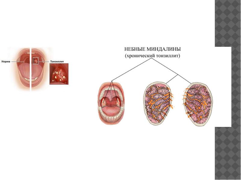 Тонзиллит схема. Хронический тонзиллит презентация. Классификация хронического тонзиллита презентация. Хронический тонзиллит схема. Миндалины в разрезе при тонзиллите.