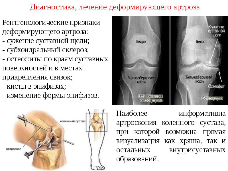 Деформирующий артроз презентация