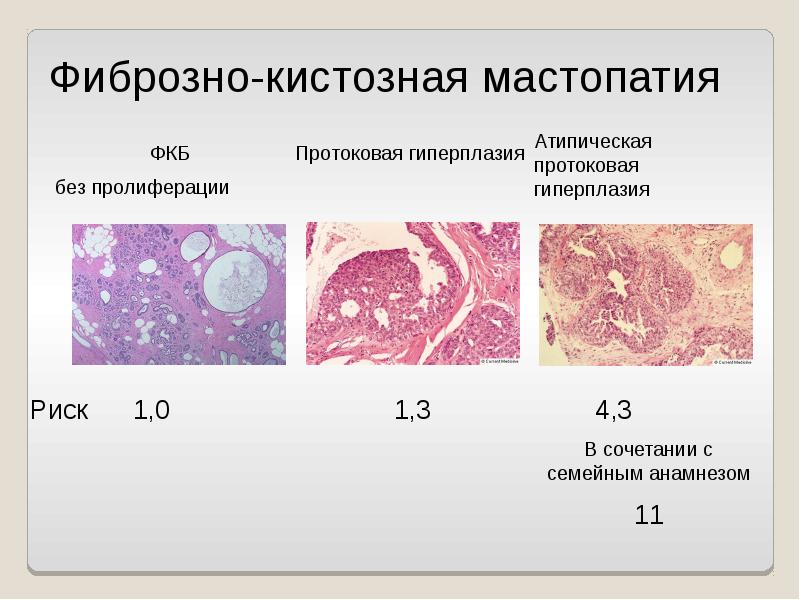 Доброкачественные заболевания молочных желез презентация