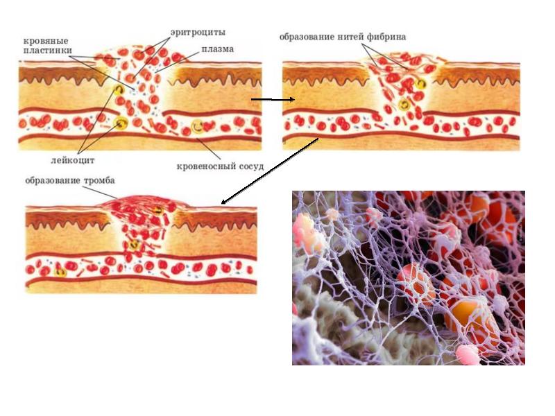 Образование тромба. Стадии образования тромба. Процесс образования тромба в крови. Образование тромба рисунок.