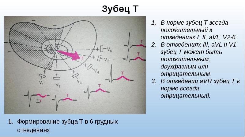 Всегда в норме. Отрицательный зубец r в грудных отведениях. Зубец р в норме всегда положителен в отведениях. Двухфазный т в грудных отведениях. Двухфазный p на ЭКГ.