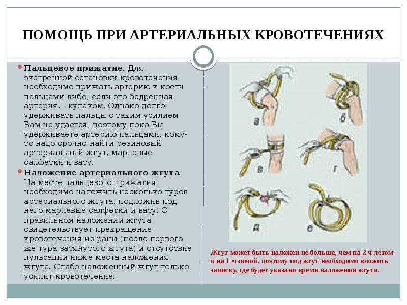 Наложение жгута при артериальном кровотечении картинка