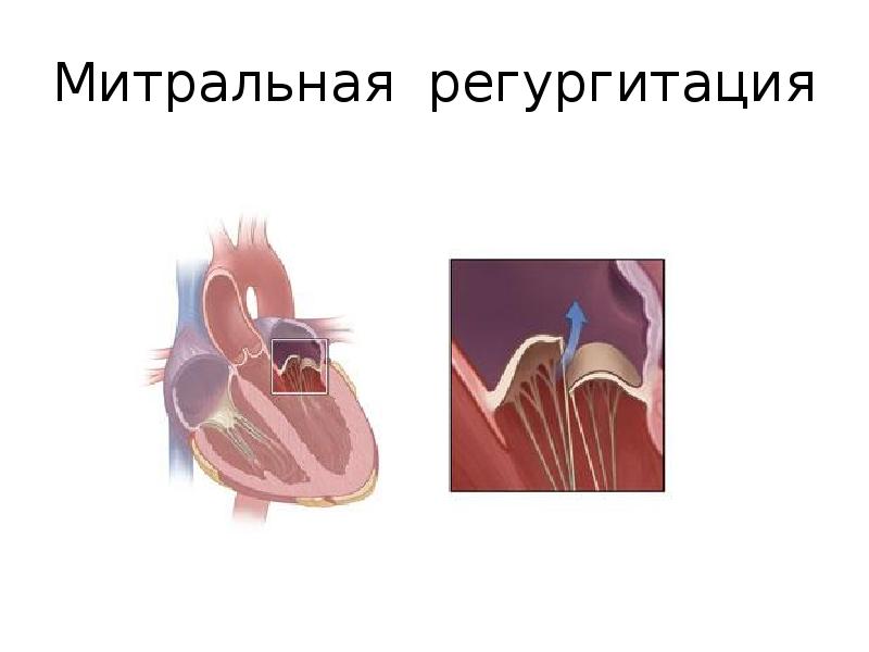 Митральная регургитация