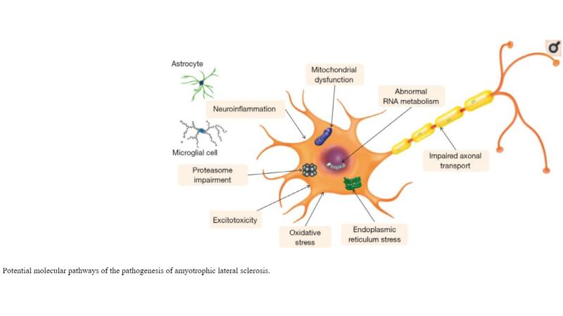 Амиотрофический боковой склероз фото