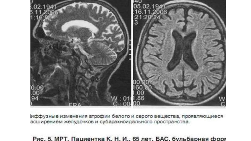 Амиотрофический боковой склероз фото