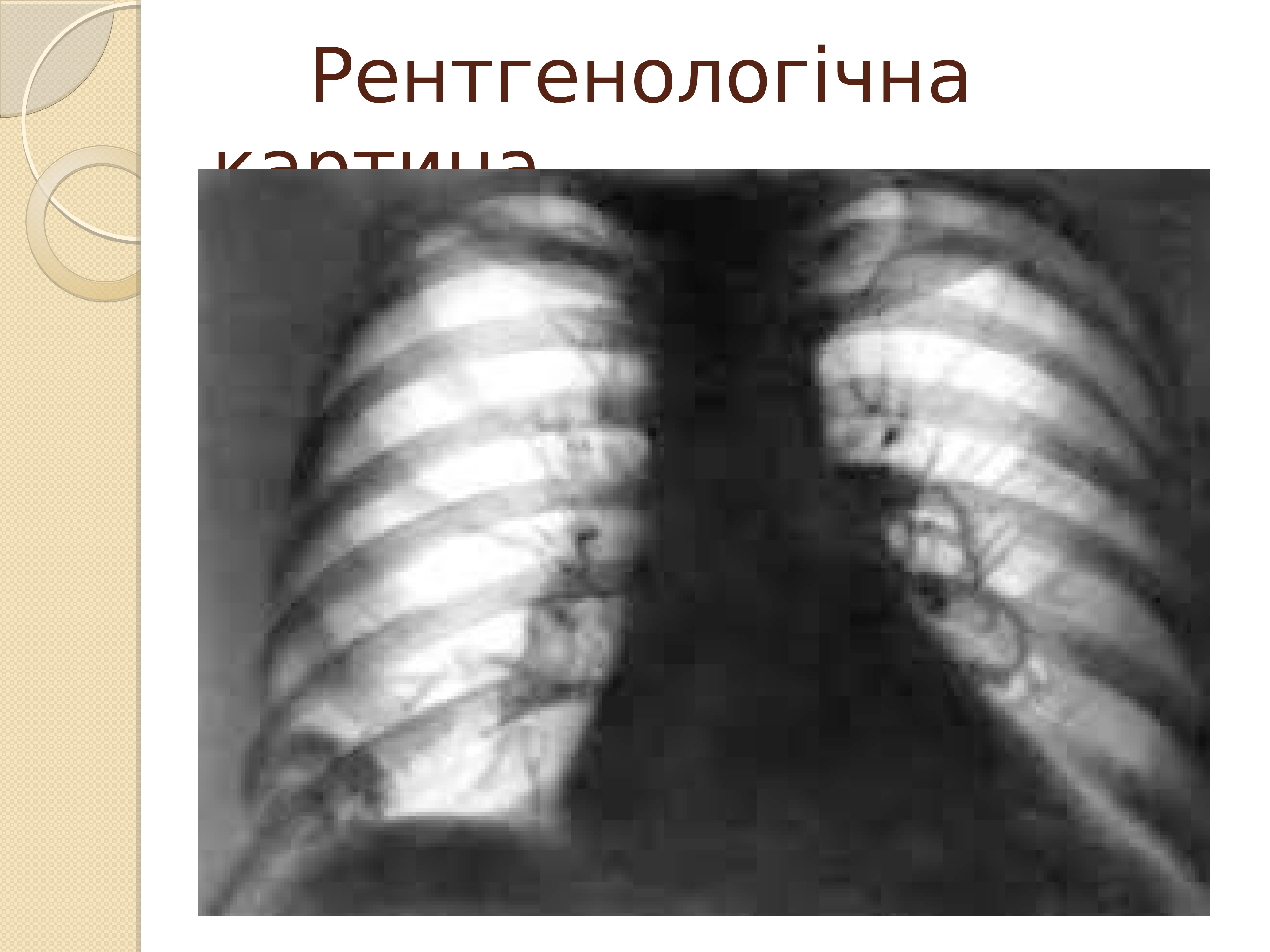 Синдром Вегенера рентген