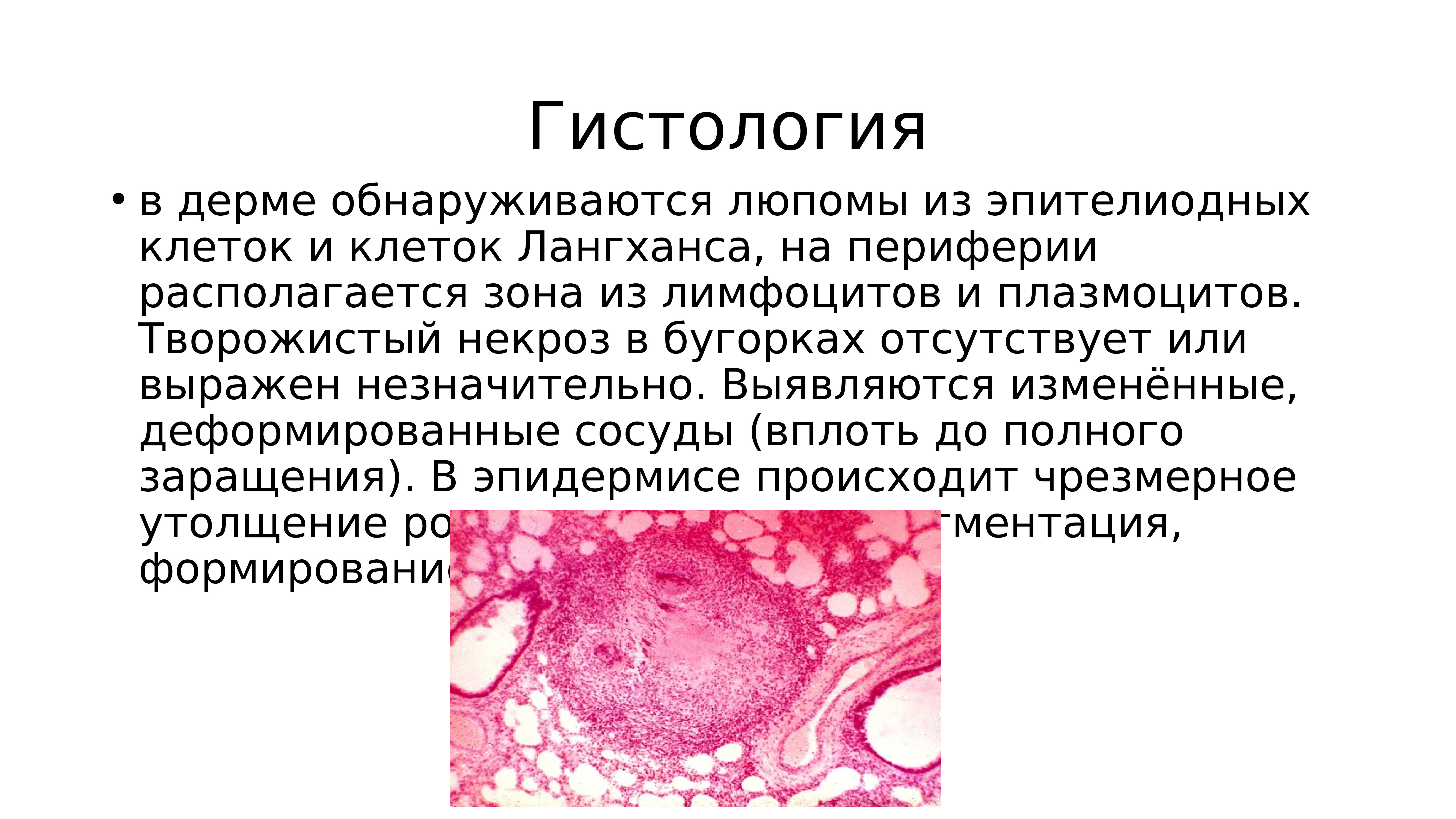 Презентация туберкулезная волчанка