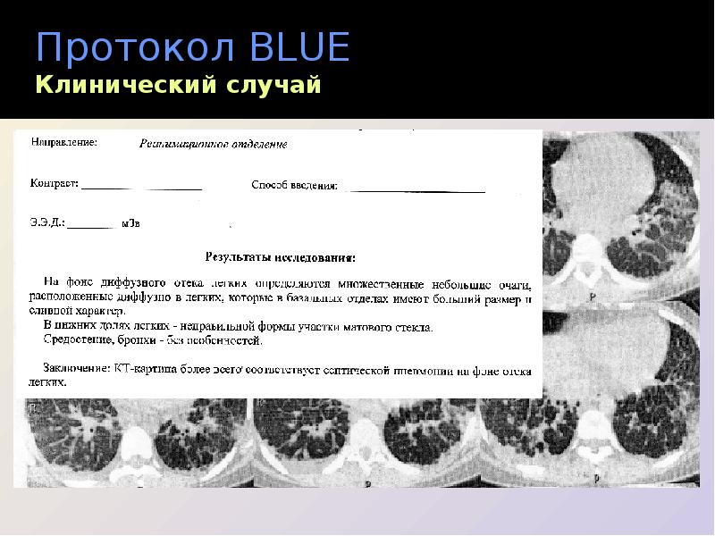 Узи легких протокол и плевры образец