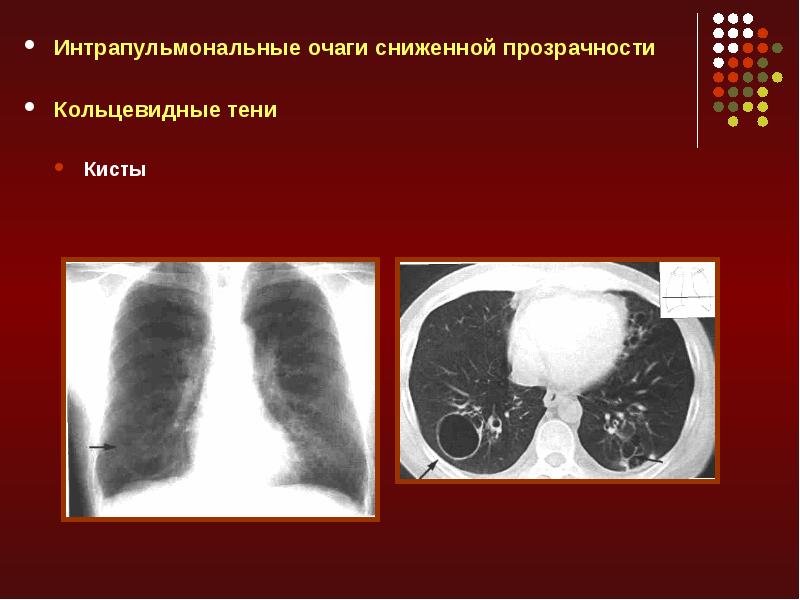 Лучевая диагностика средостения презентация