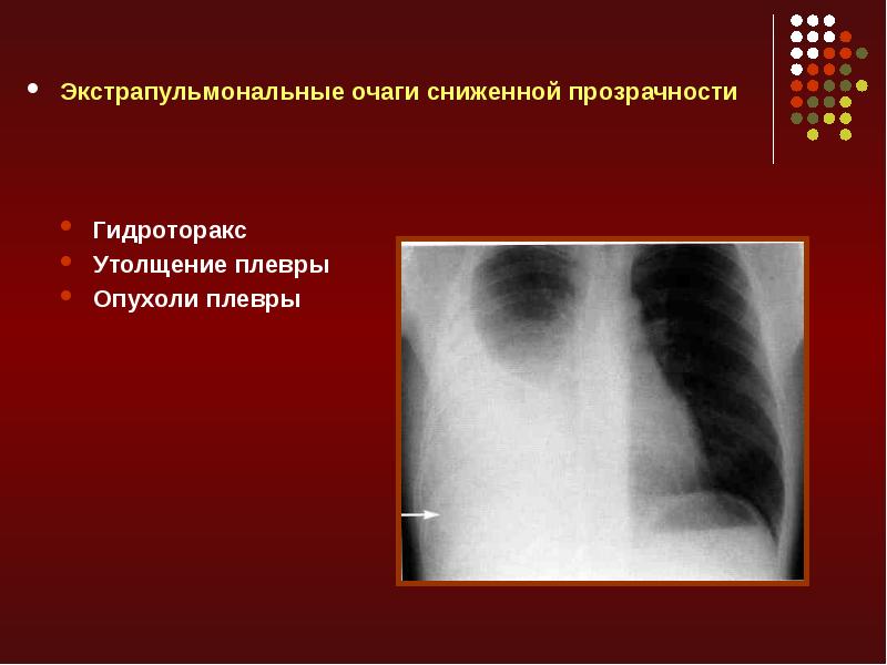 Лучевая диагностика заболеваний органов средостения презентация