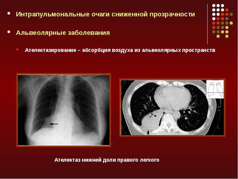 Лучевая диагностика средостения презентация