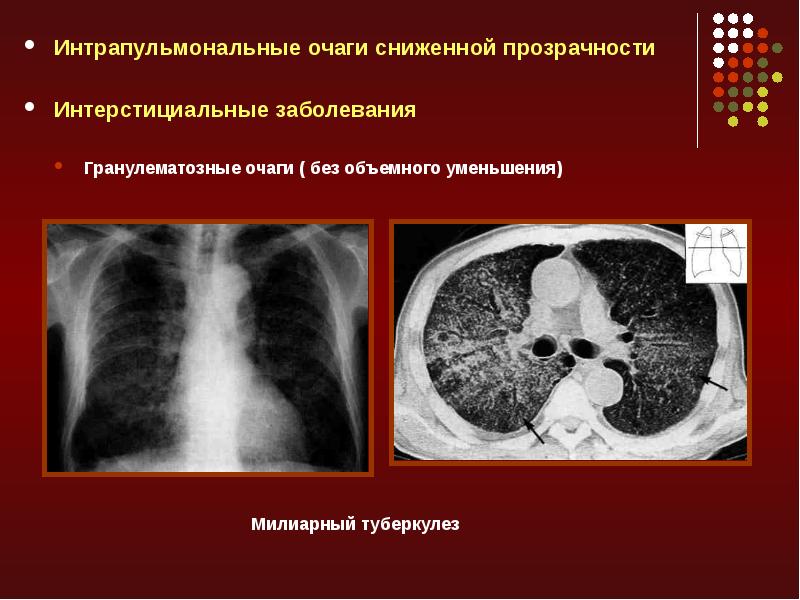 Лучевая диагностика средостения презентация